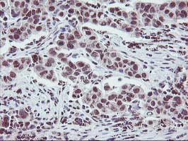 ZFP36 / Tristetraprolin Antibody - IHC of paraffin-embedded Carcinoma of Human lung tissue using anti-ZFP36 mouse monoclonal antibody. (Heat-induced epitope retrieval by 10mM citric buffer, pH6.0, 100C for 10min).