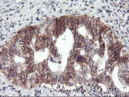 ZFP36 / Tristetraprolin Antibody - IHC of paraffin-embedded Carcinoma of Human pancreas tissue using anti-ZFP36 mouse monoclonal antibody. (Heat-induced epitope retrieval by 10mM citric buffer, pH6.0, 100C for 10min).
