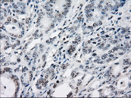 ZFP36 / Tristetraprolin Antibody - Immunohistochemical staining of paraffin-embedded Adenocarcinoma of colon tissue using anti-ZFP36 mouse monoclonal antibody. (Dilution 1:50).