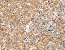 ZFP36L2 Antibody - Immunohistochemistry of paraffin-embedded Human liver cancer using ZFP36L2 Polyclonal Antibody at dilution of 1:45.