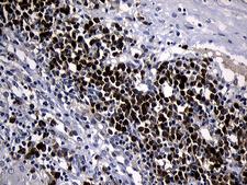 ZFP37 Antibody - Immunohistochemical staining of paraffin-embedded Carcinoma of Human bladder tissue using anti-ZFP37 mouse monoclonal antibody. (Heat-induced epitope retrieval by 1mM EDTA in 10mM Tris buffer. (pH8.5) at 120°C for 3 min. (1:150)