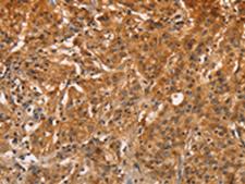 ZFP64 Antibody - Immunohistochemistry of paraffin-embedded Human gastric cancer tissue  using ZFP64  Polyclonal Antibody at dilution of 1:60(×200)