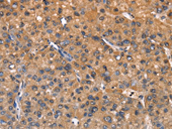 ZFP64 Antibody - Immunohistochemistry of paraffin-embedded Human liver cancer tissue  using ZFP64  Polyclonal Antibody at dilution of 1:60(×200)