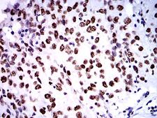 ZFP91 Antibody - Immunohistochemical analysis of paraffin-embedded ovarian cancer tissues using ZFP91 mouse mAb with DAB staining.