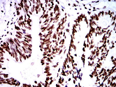 ZFP91 Antibody - Immunohistochemical analysis of paraffin-embedded rectum cancer tissues using ZFP91 mouse mAb with DAB staining.