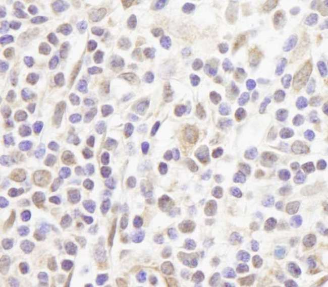 ZFPM1 / FOG1 Antibody - Detection of Human FOG1/ZFPM1 by Immunohistochemistry. Sample: FFPE section of human Hodgkin's Lymphoma. Antibody: Affinity purified rabbit anti-FOG1/ZFPM1 used at a dilution of 1:250.