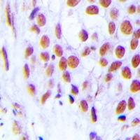 ZFPM2 / FOG2 Antibody - Immunohistochemical analysis of FOG2 staining in human breast cancer formalin fixed paraffin embedded tissue section. The section was pre-treated using heat mediated antigen retrieval with sodium citrate buffer (pH 6.0). The section was then incubated with the antibody at room temperature and detected using an HRP polymer system. DAB was used as the chromogen. The section was then counterstained with hematoxylin and mounted with DPX.