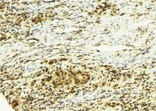ZFPM2 / FOG2 Antibody - 1:100 staining human breast carcinoma tissue by IHC-P. The sample was formaldehyde fixed and a heat mediated antigen retrieval step in citrate buffer was performed. The sample was then blocked and incubated with the antibody for 1.5 hours at 22°C. An HRP conjugated goat anti-rabbit antibody was used as the secondary.