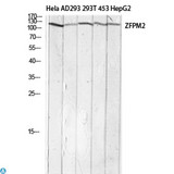 ZFPM2 / FOG2 Antibody - Immunohistochemistry (IHC) analysis of paraffin-embedded Human Breast Cancer, antibody was diluted at 1:100.