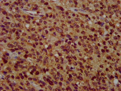 ZFX Antibody - Immunohistochemistry image at a dilution of 1:400 and staining in paraffin-embedded human glioma cancer performed on a Leica BondTM system. After dewaxing and hydration, antigen retrieval was mediated by high pressure in a citrate buffer (pH 6.0) . Section was blocked with 10% normal goat serum 30min at RT. Then primary antibody (1% BSA) was incubated at 4 °C overnight. The primary is detected by a biotinylated secondary antibody and visualized using an HRP conjugated SP system.