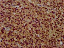 ZFX Antibody - Immunohistochemistry image at a dilution of 1:400 and staining in paraffin-embedded human glioma cancer performed on a Leica BondTM system. After dewaxing and hydration, antigen retrieval was mediated by high pressure in a citrate buffer (pH 6.0) . Section was blocked with 10% normal goat serum 30min at RT. Then primary antibody (1% BSA) was incubated at 4 °C overnight. The primary is detected by a biotinylated secondary antibody and visualized using an HRP conjugated SP system.