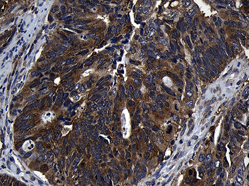 ZFYVE1 / DFCP1 Antibody - Immunohistochemical staining of paraffin-embedded Adenocarcinoma of Human colon tissue using anti-ZFYVE1 mouse monoclonal antibody. (Heat-induced epitope retrieval by 1mM EDTA in 10mM Tris buffer. (pH8.5) at 120°C for 3 min. (1:500)
