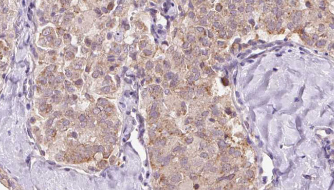 ZFYVE16 Antibody - 1:100 staining human thyroid carcinoma tissue by IHC-P. The sample was formaldehyde fixed and a heat mediated antigen retrieval step in citrate buffer was performed. The sample was then blocked and incubated with the antibody for 1.5 hours at 22°C. An HRP conjugated goat anti-rabbit antibody was used as the secondary.