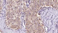 ZFYVE16 Antibody - 1:100 staining human thyroid carcinoma tissue by IHC-P. The sample was formaldehyde fixed and a heat mediated antigen retrieval step in citrate buffer was performed. The sample was then blocked and incubated with the antibody for 1.5 hours at 22°C. An HRP conjugated goat anti-rabbit antibody was used as the secondary.