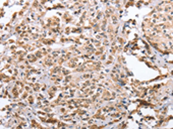 ZFYVE16 Antibody - Immunohistochemistry of paraffin-embedded Human prost at e cancer tissue  using ZFYVE16  Polyclonal Antibody at dilution of 1:60(×200)