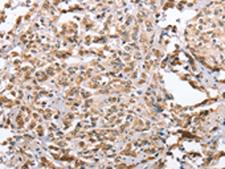 ZFYVE16 Antibody - Immunohistochemistry of paraffin-embedded Human prost at e cancer tissue  using ZFYVE16  Polyclonal Antibody at dilution of 1:60(×200)