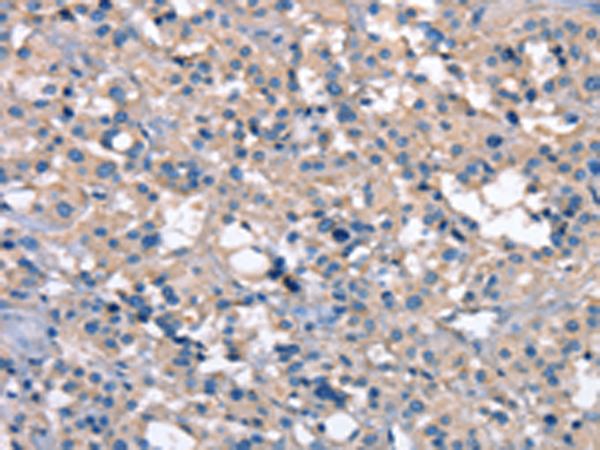 ZFYVE16 Antibody - Immunohistochemistry of paraffin-embedded Human thyroid cancer tissue  using ZFYVE16  Polyclonal Antibody at dilution of 1:60(×200)