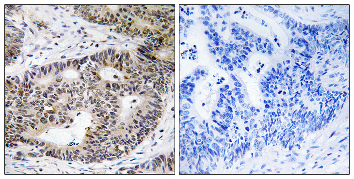 ZFYVE19 Antibody - Immunohistochemistry analysis of paraffin-embedded human colon carcinoma tissue, using ZFYVE19 Antibody. The picture on the right is blocked with the synthesized peptide.