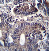 ZFYVE19 Antibody - ZFYVE19 Antibody immunohistochemistry of formalin-fixed and paraffin-embedded human colon carcinoma followed by peroxidase-conjugated secondary antibody and DAB staining.