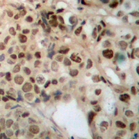 ZFYVE19 Antibody - Immunohistochemical analysis of ZFYVE19 staining in human breast cancer formalin fixed paraffin embedded tissue section. The section was pre-treated using heat mediated antigen retrieval with sodium citrate buffer (pH 6.0). The section was then incubated with the antibody at room temperature and detected with HRP and DAB as chromogen. The section was then counterstained with hematoxylin and mounted with DPX.
