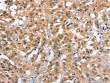 ZFYVE19 Antibody - Immunohistochemistry of paraffin-embedded Human thyroid cancer tissue  using ZFYVE19  Polyclonal Antibody at dilution of 1:61(×200)