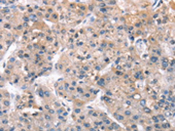 ZFYVE19 Antibody - Immunohistochemistry of paraffin-embedded Human liver cancer tissue  using ZFYVE19  Polyclonal Antibody at dilution of 1:61(×200)