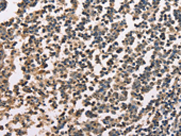 ZFYVE19 Antibody - Immunohistochemistry of paraffin-embedded Human tonsil tissue  using ZFYVE19  Polyclonal Antibody at dilution of 1:60(×200)