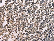 ZFYVE19 Antibody - Immunohistochemistry of paraffin-embedded Human tonsil tissue  using ZFYVE19  Polyclonal Antibody at dilution of 1:60(×200)