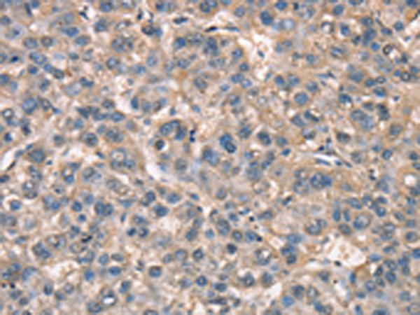 ZFYVE19 Antibody - Immunohistochemistry of paraffin-embedded Human liver cancer tissue  using ZFYVE19  Polyclonal Antibody at dilution of 1:60(×200)