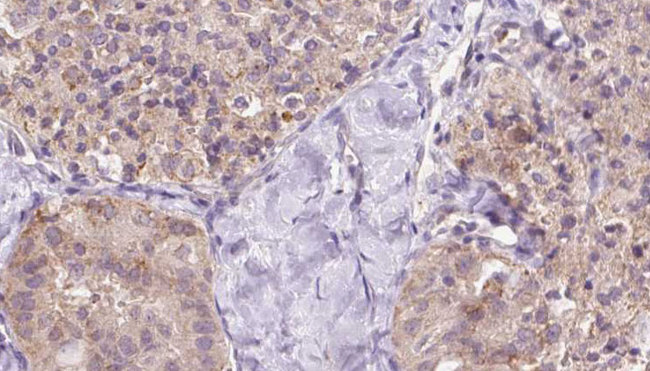 ZFYVE27 / Protrudin Antibody - 1:100 staining human thyroid carcinoma tissue by IHC-P. The sample was formaldehyde fixed and a heat mediated antigen retrieval step in citrate buffer was performed. The sample was then blocked and incubated with the antibody for 1.5 hours at 22°C. An HRP conjugated goat anti-rabbit antibody was used as the secondary.