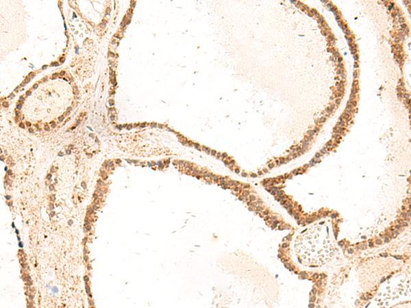 ZFYVE27 / Protrudin Antibody - Immunohistochemistry of paraffin-embedded Human thyroid cancer tissue  using ZFYVE27 Polyclonal Antibody at dilution of 1:50(×200)