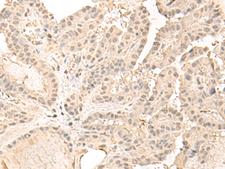 ZGPAT Antibody - Immunohistochemistry of paraffin-embedded Human thyroid cancer tissue  using ZGPAT Polyclonal Antibody at dilution of 1:35(×200)