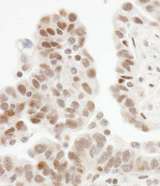 ZHX1 Antibody - Detection of Human ZHX1 by Immunohistochemistry. Sample: FFPE section of human ovarian carcinoma. Antibody: Affinity purified rabbit anti-ZHX1 used at a dilution of 1:1000 (1 ug/ml). Detection: DAB.