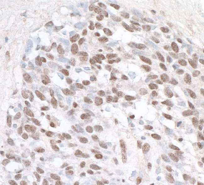 ZHX1 Antibody - Detection of human ZHX1 by immunohistochemistry. Sample: FFPE section of human lung carcinoma. Antibody: Affinity purified rabbit anti- ZHX1 used at a dilution of 1:1,000 (1µg/ml). Detection: DAB