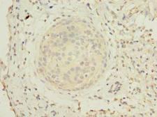 ZHX1 Antibody - Immunohistochemistry of paraffin-embedded human cervical cancer using antibody at dilution of 1:100.