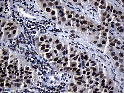 ZHX2 / RAF Antibody - Immunohistochemical staining of paraffin-embedded Carcinoma of Human lung tissue using anti-ZHX2 mouse monoclonal antibody. (Heat-induced epitope retrieval by 1mM EDTA in 10mM Tris buffer. (pH8.5) at 120°C for 3 min. (1:150)