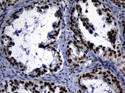 ZHX2 / RAF Antibody - Immunohistochemical staining of paraffin-embedded Adenocarcinoma of Human ovary tissue using anti-ZHX2 mouse monoclonal antibody. (Heat-induced epitope retrieval by 1mM EDTA in 10mM Tris buffer. (pH8.5) at 120°C for 3 min. (1:150)