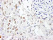 ZHX3 Antibody - Detection of Human ZHX3 by Immunohistochemistry. Sample: FFPE section of human breast carcinoma. Antibody: Affinity purified rabbit anti-ZHX3 used at a dilution of 1:500.