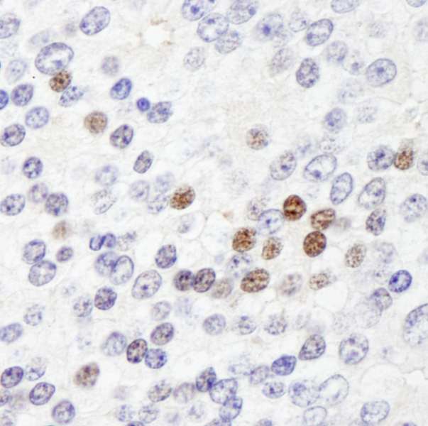ZHX3 Antibody - Detection of Human ZHX3 by Immunohistochemistry. Sample: FFPE section of human prostate carcinoma. Antibody: Affinity purified rabbit anti-ZHX3 used at a dilution of 1:500.