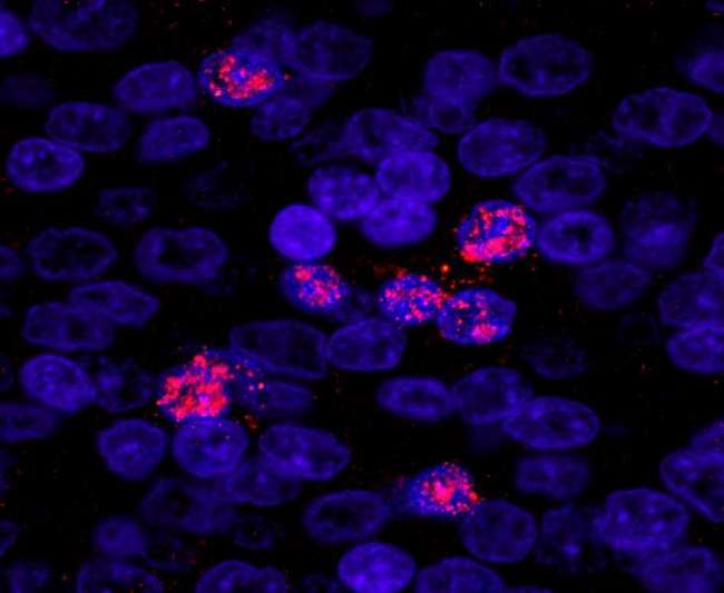 ZHX3 Antibody - Detection of Human ZHX3 by Immunofluorescence. Sample: FFPE section of human prostate carcinoma. Antibody: Affinity purified rabbit anti-ZHX3 used at a dilution of 1:100. Detection: Red-fluorescent goat anti-rabbit IgG highly cross-adsorbed Antibody used at a dilution of 1:100.