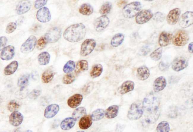ZHX3 Antibody - Detection of Human ZHX3 by Immunohistochemistry. Sample: FFPE section of human prostate carcinoma. Antibody: Affinity purified rabbit anti-ZHX3 used at a dilution of 1:1000 (1 ug/ml). Detection: DAB.