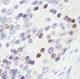 ZHX3 Antibody - Detection of Human ZHX3 by Immunohistochemistry. Sample: FFPE section of human prostate carcinoma. Antibody: Affinity purified rabbit anti-ZHX3 used at a dilution of 1:1000 (0.2 ug/ml). Detection: DAB.