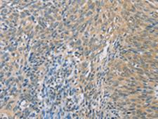 ZHX3 Antibody - Immunohistochemistry of paraffin-embedded Human cervical cancer tissue  using ZHX3  Polyclonal Antibody at dilution of 1:100(×200)