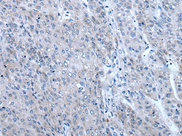 ZIC / ZIC1 Antibody - Immunohistochemistry of paraffin-embedded Human liver cancer tissue  using ZIC1 Polyclonal Antibody at dilution of 1:65(×200)