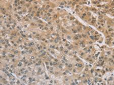 ZIC2 Antibody - Immunohistochemistry of paraffin-embedded Human liver cancer tissue  using ZIC2  Polyclonal Antibody at dilution of 1:100(×200)