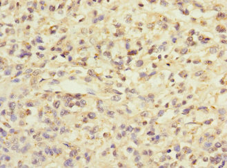 ZIC3 Antibody - Immunohistochemistry of paraffin-embedded human melanoma at dilution 1:100