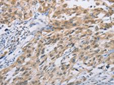 ZIC5 Antibody - Immunohistochemistry of paraffin-embedded Human esophagus cancer tissue  using ZIC5  Polyclonal Antibody at dilution of 1:100(×200)