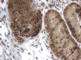 ZIM2 Antibody - IHC of paraffin-embedded Adenocarcinoma of Human colon tissue using anti-ZIM2 mouse monoclonal antibody.