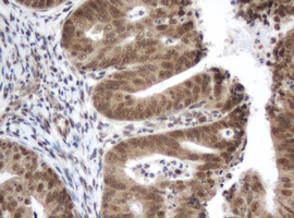 ZIM2 Antibody - IHC of paraffin-embedded Adenocarcinoma of Human endometrium tissue using anti-ZIM2 mouse monoclonal antibody.