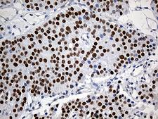 ZKSCAN1 / ZNF36 Antibody - Immunohistochemical staining of paraffin-embedded Carcinoma of Human pancreas tissue using anti-ZKSCAN1 mouse monoclonal antibody. (Heat-induced epitope retrieval by 1mM EDTA in 10mM Tris buffer. (pH8.5) at 120°C for 3 min. (1:2000)